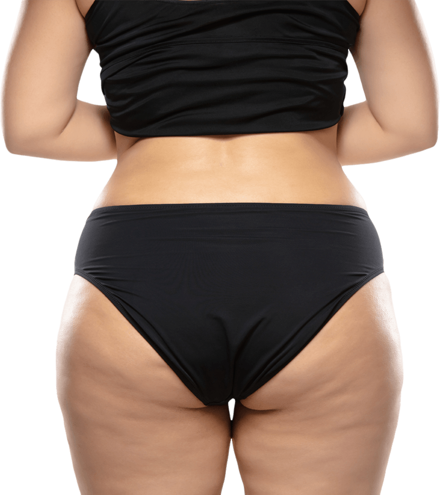 Cellulite